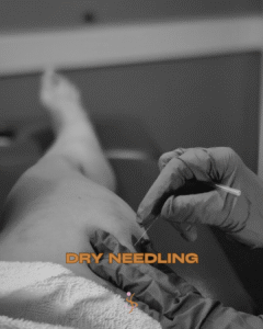 Dry Needling